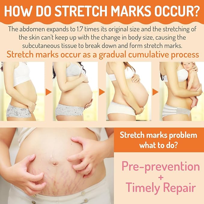Stretch Mark Belly Butter-Packed with Vitamin E, Coconut Oil, and Sunflower Seed Oil to Protect, Soothe, and Rejuvenate Skin - Safe for Pregnancy and Nursing-Repair Stretch Marks and Scars.7.055oz