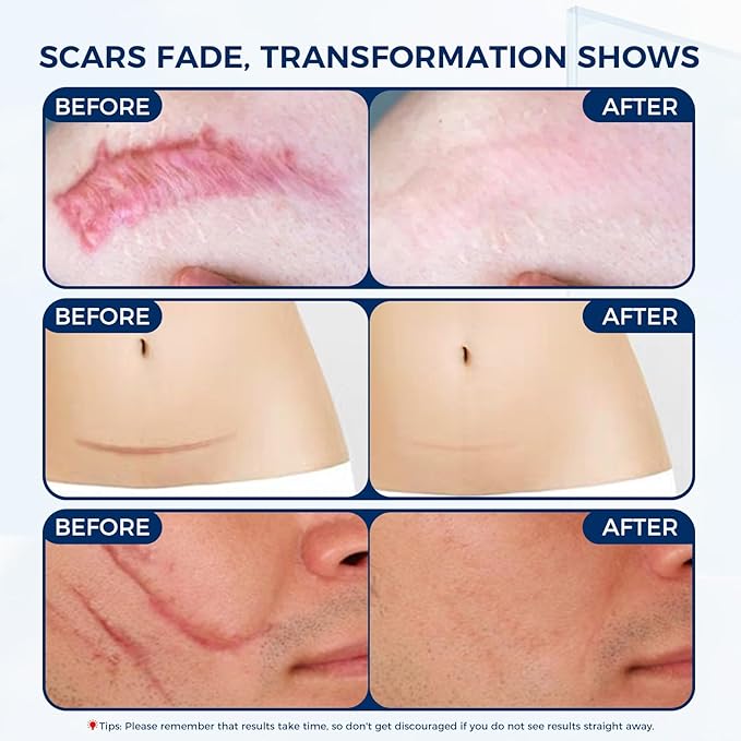 OUKEYA Silicone Scar Gel - 100% Silicone Cream Perfect for Sensitive Skin, Say Goodbye to Old and New Scars (30ml)
