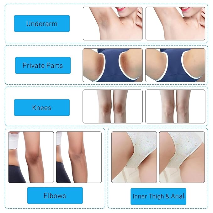 Skin Whitening Cream Bleaching Cream for Body Intimate Area, Private Parts, Underarm, Knees, Elbows, Inner Thigh, Bikini Areas, Bikini Line, Skin Lightening Dark Spot Remover For Intimate Areas 60ML