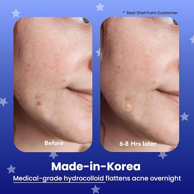 AVARELLE Spot Pimple Patches for Face | Good Night Acne Cover | Hydrocolloid with Tea Tree Oil | Acne Spot Treatment (12-14 mm, 96 ct)