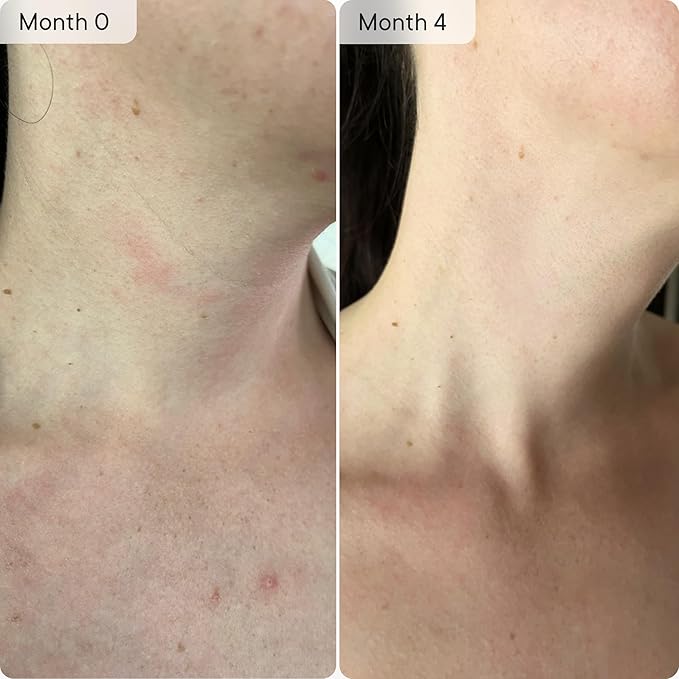 Qure Neck & Décolletage & Chest LED System, Red Light Therapy with 2 Wavelengths of Light, Red 633nm and Near-Infrared 830nm