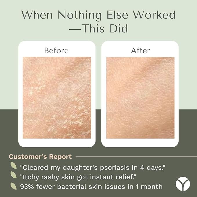 Yobee Body & Face Cream for Dry, Itchy Skin, Eczema & Psoriasis, Dermatologist Formulated, Probiotics, Honey, Turmeric, Vitamins B12 & E, Ceramides, Shea Butter, Fragrance Free, For Kids & Adults