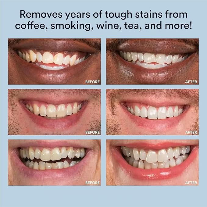 WHITE SMILE Teeth Whitening Kit with LED Light, 35% Carbamide Peroxide 3 Gel Syringes, 10-Minute Treatment, Non-Sensitive Formula, Helps to Remove Stains from Coffee, Smoking, Wines, Soda, Food