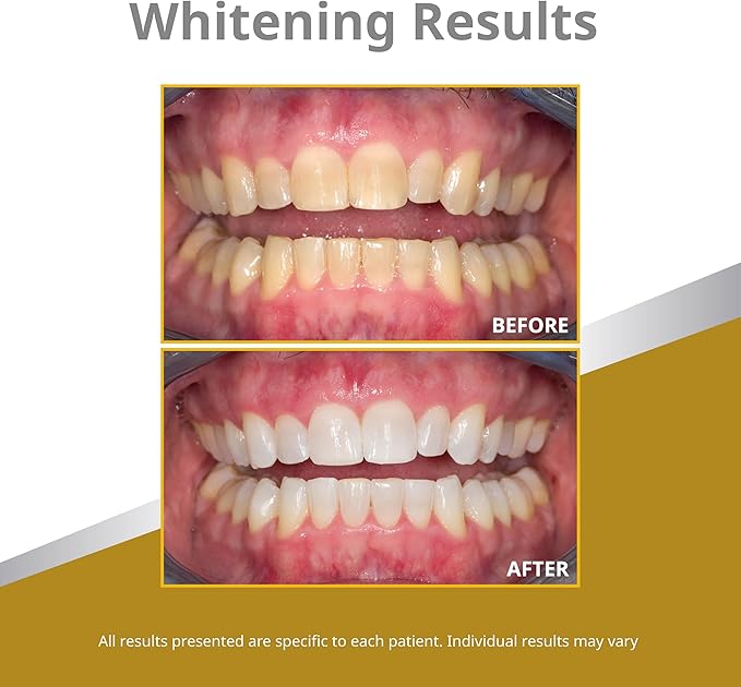 Opalescence 45% Syringes Teeth Whitening Gel - with PF - (4 Syringes) Refill Kit Carbamide Peroxide. Made by Ultradent, in Mint Flavor. Tooth Whitening 5359-2