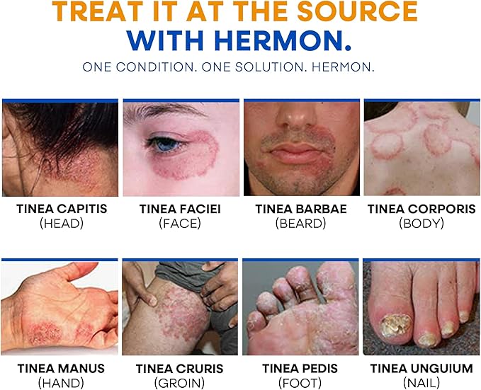 Hermon Powerful Ringworm Antifungal Soap – Treatment for Ringworm, Athlete’s Foot & Jock Itch – Tea Tree Oil & Sulfur Formula – Fungal Soap for Daily Body Wash – 2 Pack