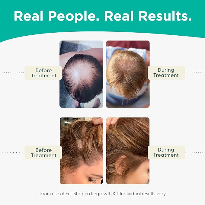 Shapiro MD Hair Growth Experts Vegan Hair Loss Shampoo for Thinning Hair | Experience Healthier, Fuller and Thicker Looking Hair (1 Month Supply) (Pack of 2)