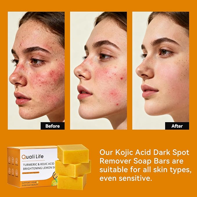 Turmeric Soap For Dark Spot - Kojic Acid Soap Bar with Vitamin C for Face & Body, Natural Ingredients Handmade Soaps for Brightening & Moisturizing, 3 Bars