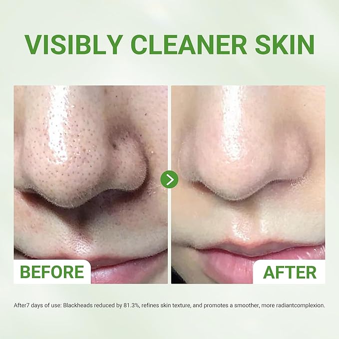 Dr.Leo 3X Acid Clay Mask with Amazonian White & Glacier Clay, Deep Cleansing Facial Skincare for Pore Minimizing Oil Control & Detox, Face Mask for All Skin Types, 3.53 oz