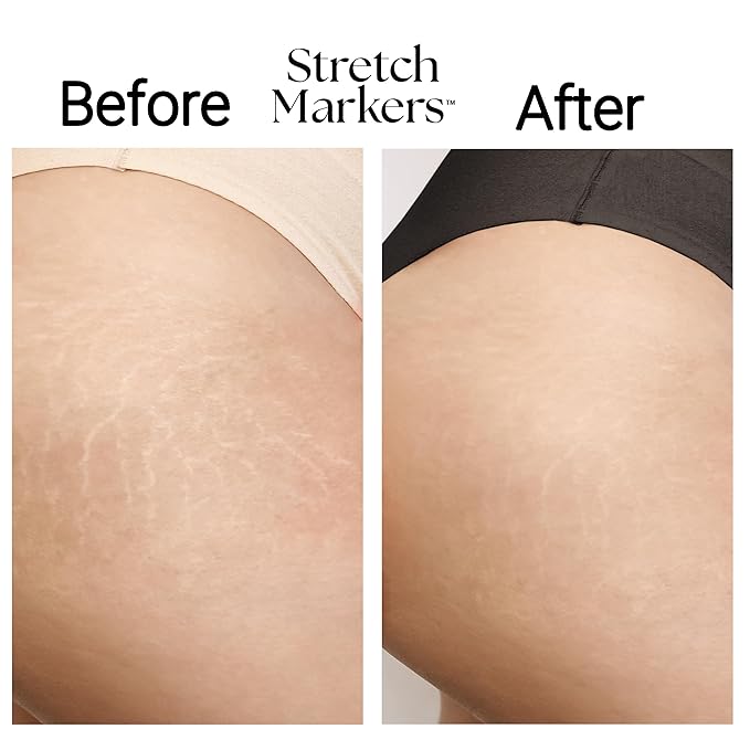 StretchMarkers Therapy Stretch Mark Cream – Visibly Reduces and Treats, Stretch Marks Removal with Retinol, Hyaluronic Acid, Bioactive Peptides & 3D Stem Cell Technology, 1 fl oz