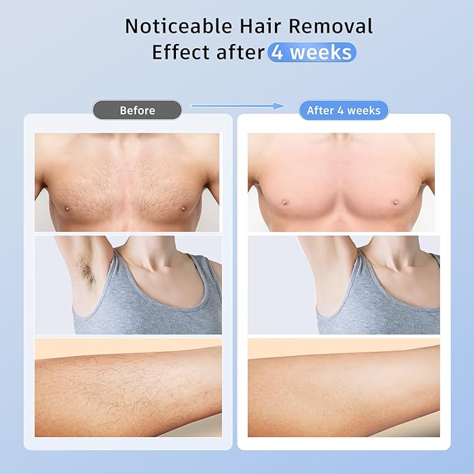 Laser Hair Removal Ubroo IPL Hair Removal Device with 5℃ Ice Cooling,Painless Laser Hair Removal for Women and Men,Full Body Use for Legs,Bikini,Armpits (Gold)
