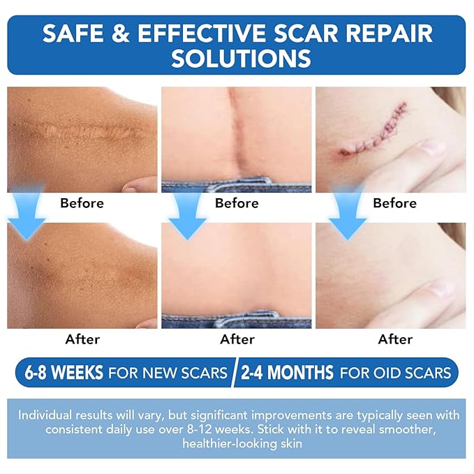 Clear Silicone Scar Sheets, Silicone Scar Tape(1.6"x 60" Roll-1.5M) - Reusable, Soft & Medical Grade Adhesive Tape for Old & New Scars, C-Section, Surgery, Keloid & Acne Scars