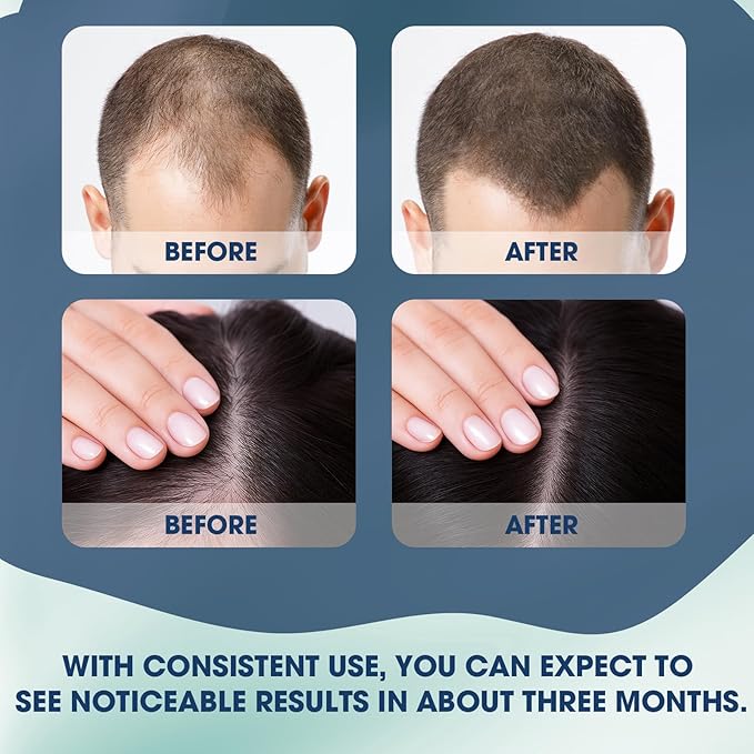 Hair Growth Serum Roll On, Suitable for All Hair Types Prevents Hair Loss Nourishes Hair Follicles Achieve Thicker Hair for Men & Women