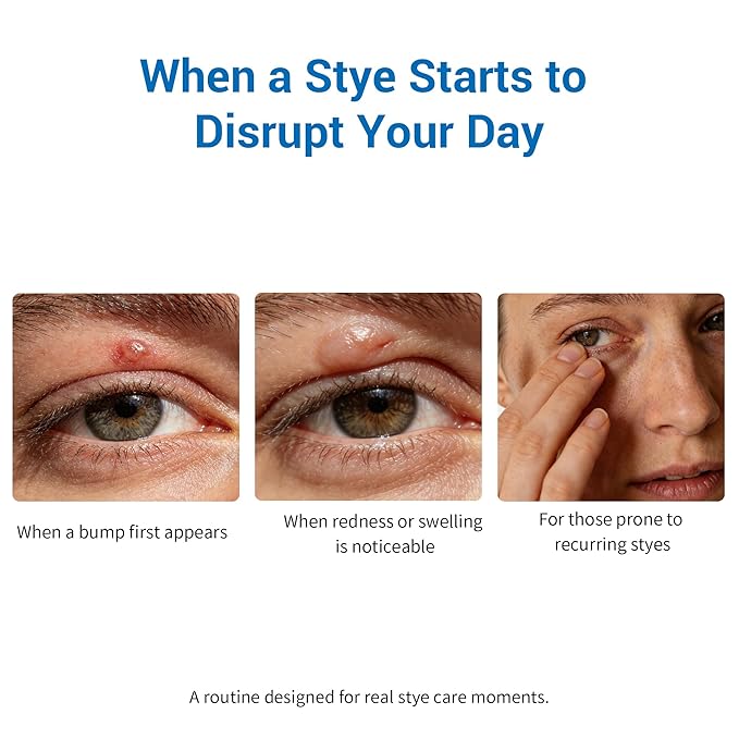 Stye Eye Treatment Kit, Stye Relief Rollerball Serum and Eye Patches for Styes, Chalazions and Blepharitis Treatment for Eyelids, Stye Eye Compress, Clear Eyes Redness Relief, Sleep Eye Mask