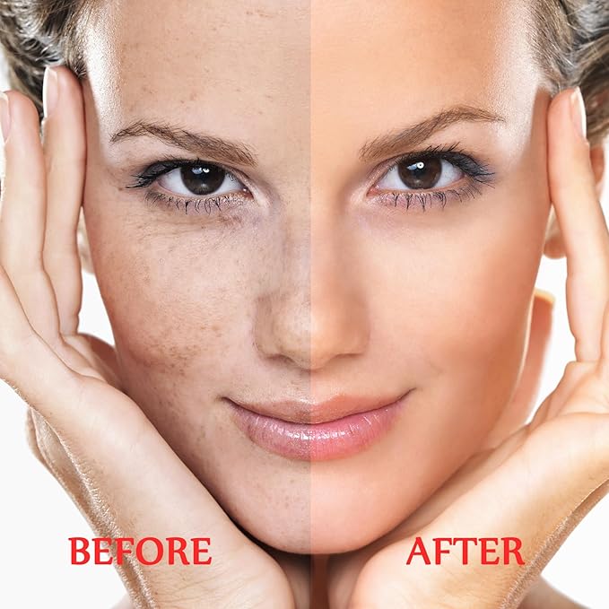 Dark Spot Remover for Face and Body - Dark Spot Corrector Serum for Acne Scars, Melasma, Age, Sun, Black Spots | Advanced Formula for Women and Men |Suitable for Oily, Dry and Combination Skin, 1.35FL