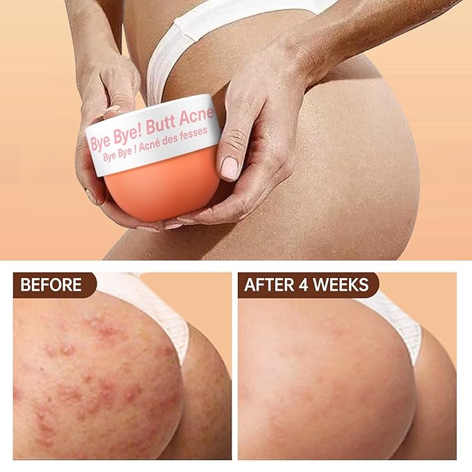 Butt Acne Clearing Treatment, Body Cream for Back, Buttocks, Thigh & Chest Acne, Skin Clearing Lotion for Men & Women 5.46 oz