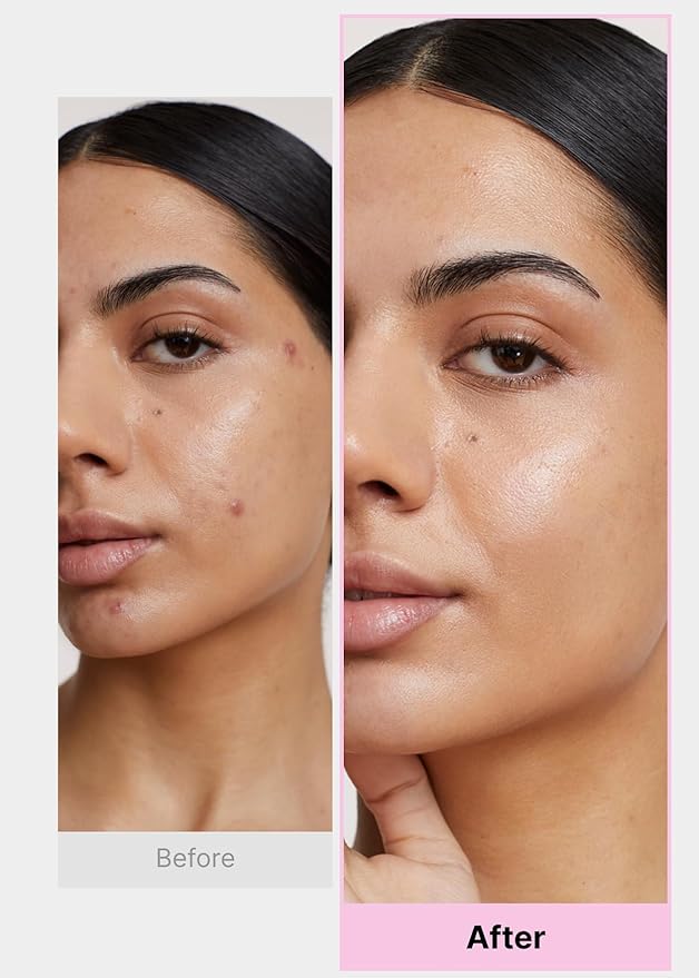 EasyDerm Multi-Step Pimple Patch Set – 4-Type Korean Pimple Patches + Free 2-in-1 Dual-Tip Extractor for Complete Skincare Stocking Stuffer Holiday Gift