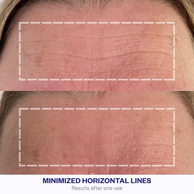 Wrinkles Schminkles Facial Smoothing Set | Mouth & Lip 2-Pack | Eye Wrinkle Patches 3-Pairs | Forehead Wrinkle Patches 2-Pack | Reusable Hypoallergenic Silicone Smoothing Pads