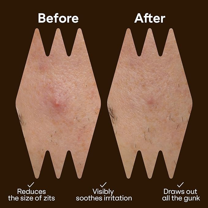 Cute Pimple Patches for Face - Tattoo Style Hydrocolloid Acne Patches (Confidence Patch) with Star Designs (66 Cute Patches) - Vegan & Cruelty-Free