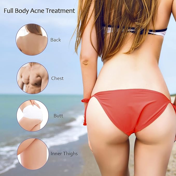 Stubborn Acne Pimple Eraser Cream, Glycolic Acid, Salicylic Acid, Niacinamide, Joseon Glow, Acne and Bacne treatment, 30g