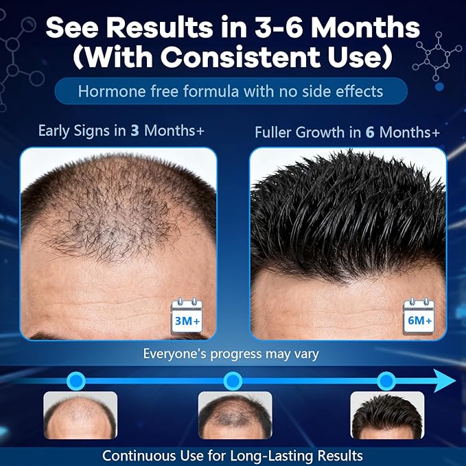5% Topical Minoxidil Foam, Aerosol Minoxidil for Men, Infused with Biotin, Hair Growth Treatment, Supports Thicker and Fuller Hair & Beard Unscented (Minoxidil Foam, 4.22oz, 2 Months Supply)