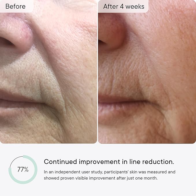 Qure Micro-Infusion Anti Wrinkle Patches for Smile Line, Frown lines, Under Eye Bags, Puffiness, Crow's Feet - Retinol, Caffeine - Dissolvable for Overnight Use - 8 Pairs