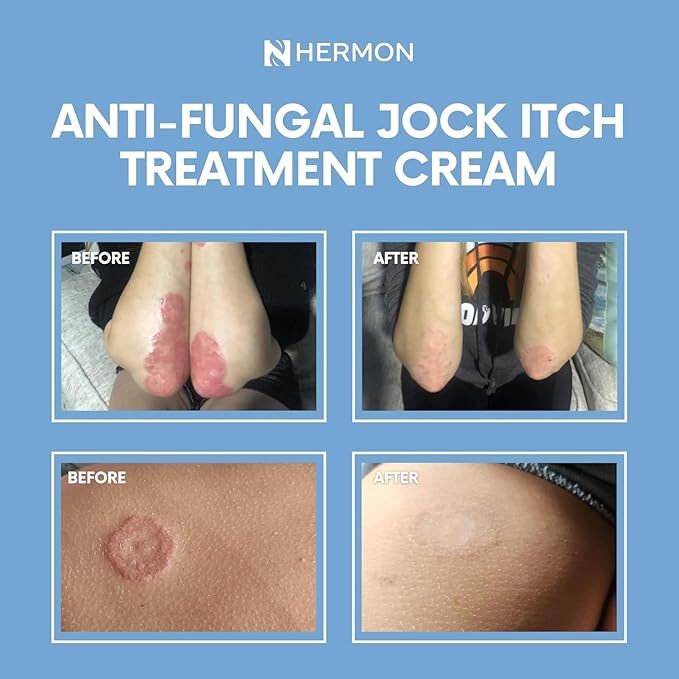 Jock Itch Antifungal Cream, Ringworm Treatment for Humans, Psoriasis Scalp Treatment, Ringworm Cream for Humans, Foot & Body Balm, Provides Soothing Relief-2 Pack