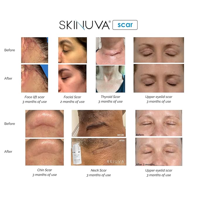 Skinuva® Next Generation Scar Cream - Advanced Scar Cream Formulated with Growth Factors (0.5 oz)