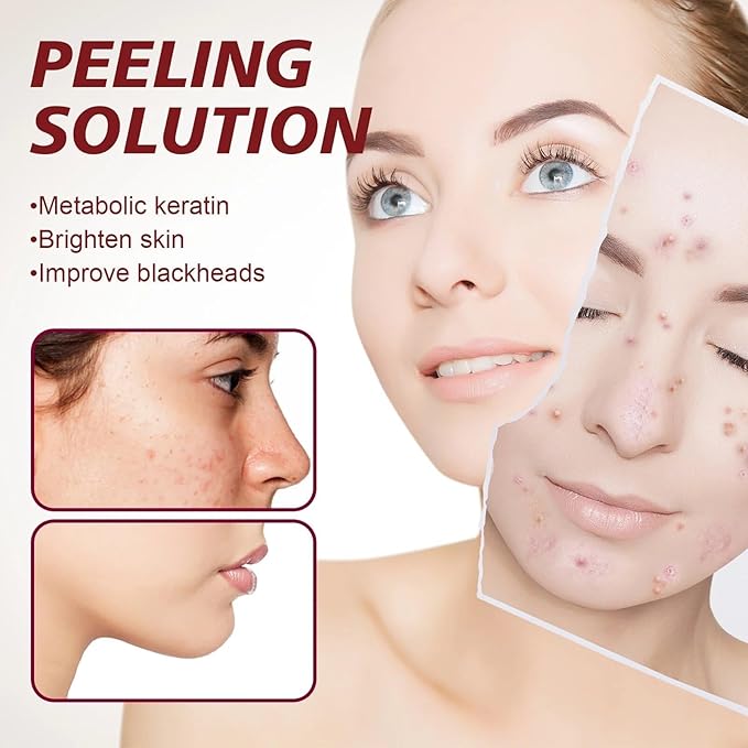 AHA 30% + BHA 2% Peeling Solution, Chemical Peel for Face at Home, BHA Liquid Exfoliant for Large Pores, Wrinkles & Fine Lines, 1.0 FlOz (1 PCS)