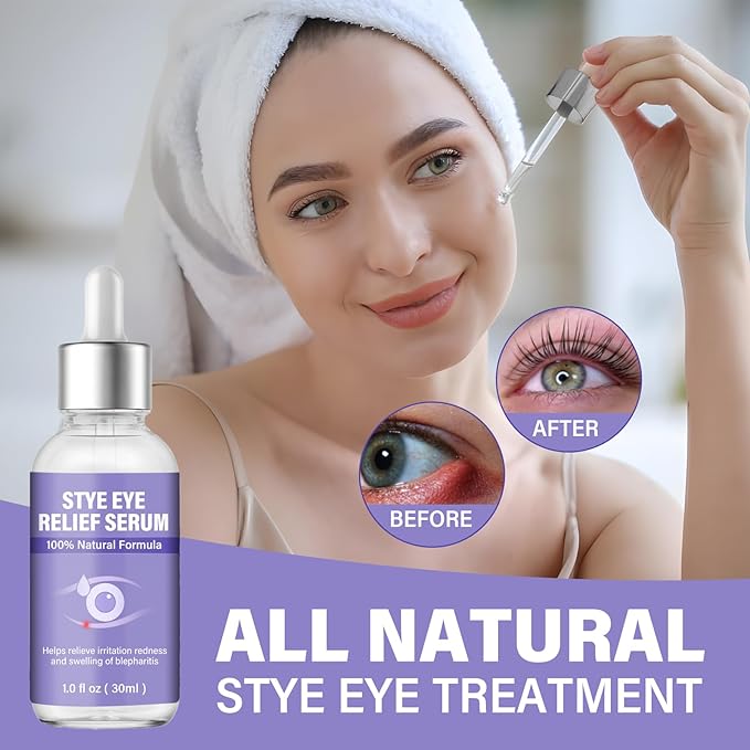 Stye Eye Treatment, Natural Stye Eye Drops for Chalazion and Blepharitis Relief, Gentle Daily Eye Care, Soothes Irritation Redness and Swelling, 1 Fl Oz / 30 Ml