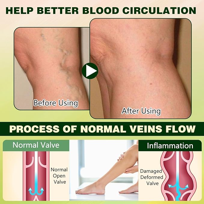 FluidEase Leg Therapy Edema Cream, Edema Relief for Legs and Feet, Natural Comprehensive Care Herbal Massage Cream for All Skin Types