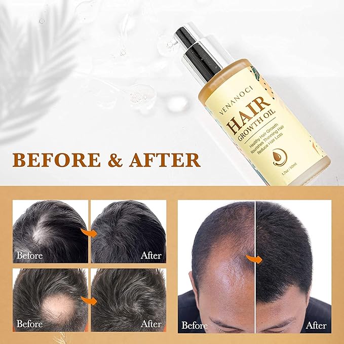 Hair Growth Oil with Rosemary & Biotin: Natural Hair Regrowth Serum for Women & Men – Anti Hair Loss & Thinning Treatment – Promotes Thicker, Fuller, Stronger, Healthier Hair – All Hair Types 2 packs