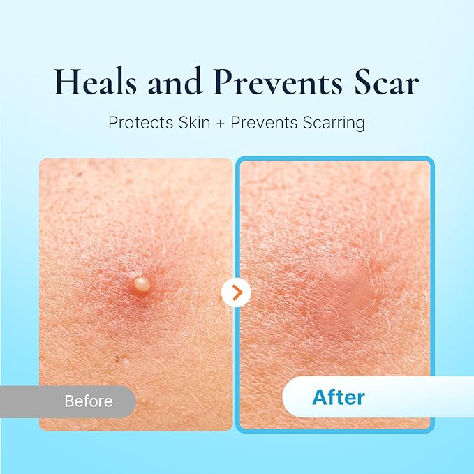 Discreet Acne Pimple Patch | Spot Cover & Treatment Solution Cystic Acne & Pimple | Hydrocolloid Facial Stickers | Waterproof Patches Invisibly Cover Pimples (4packs)