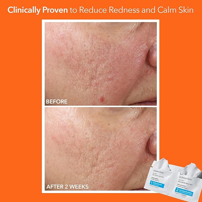 Dr. Dennis Gross Alpha Beta Ultra Gentle Daily Peel: for Dehydrated or Sensitive Skin, Uneven Tone or Texture, Fine Lines or Enlarged Pores (5 Treatments)