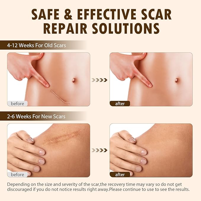 Scar Solutions Silicone Scar Stick, 60% Silicone for Face and Body Skin, Lightweight & Easy to Apply, Natural Ingredients Gentle on All Skin Types, Stick Applicator Manual Massage Suitable-2PCS