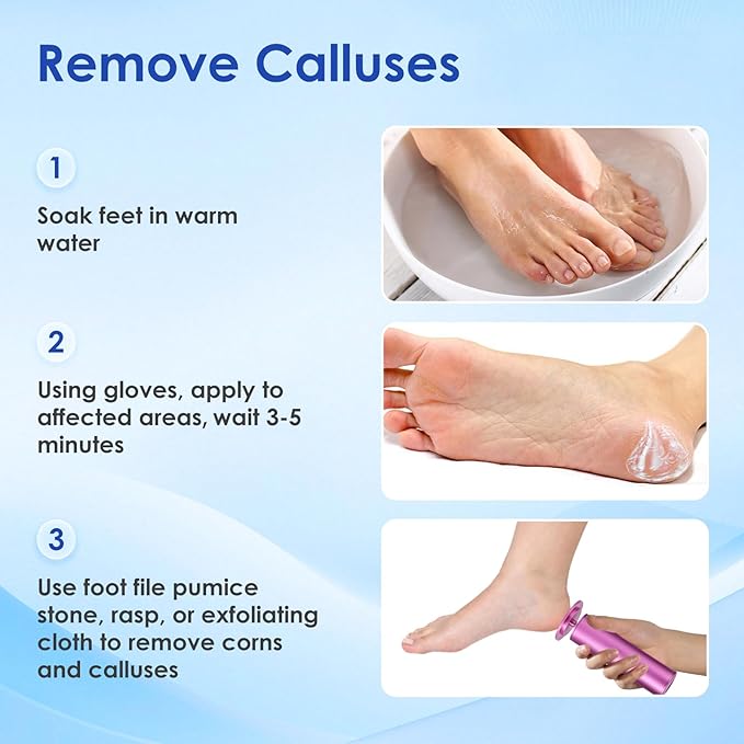 MOWLIE Professional Callus Remover for Feet – Extra Strength Foot Callus Remover Gel with 2 Glass Sandpaper Discs for Electric Foot Callus Remover,Foot Care kit - 50 ml/1.76 fl.oz