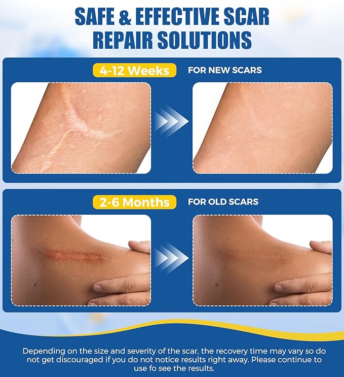 Medical Grade Silicone Scar Sheets & Tape - 1.6”x60" Roll, Ultra Soft, Hypoallergenic Rolls for Surgical, C-Section, Tummy Tuck, Keloid Scars, Stretch Marks & Burn Scar Removal