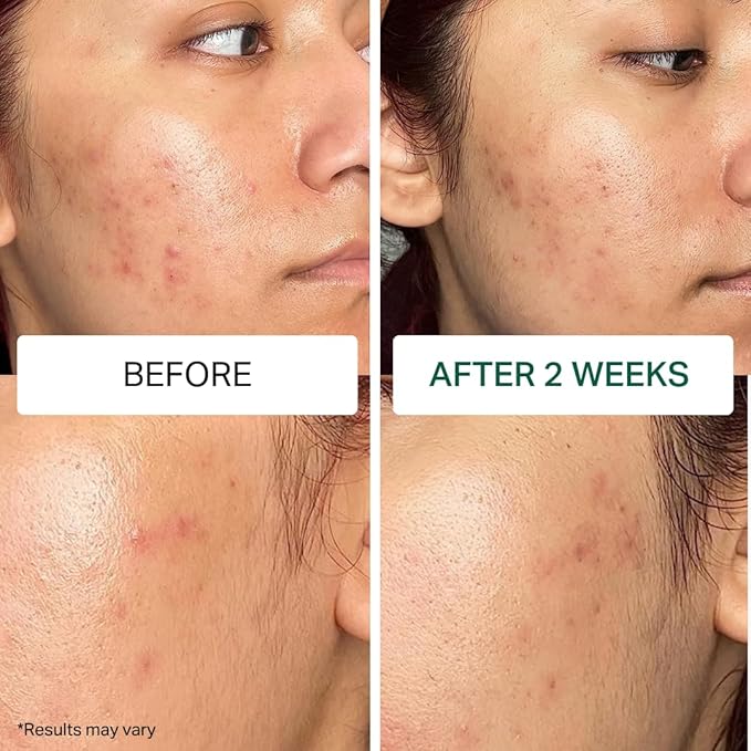 Y'OUR Acne Skincare Kit for Adults – 5-Step System with Cleanser, Day Cream, Serum, Night Cream & Mask – Fights Breakouts & Blemishes – Hydrating & Non-Comedogenic Formula