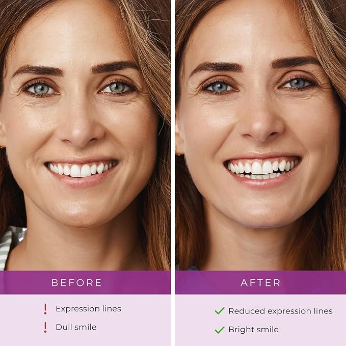 Furlesse Lip-Sticks Wrinkle Patches, Overnight Anti-Wrinkle Patches for Smile Lines, Fine Lines, and Expression Lines, Non-invasive Lip Patches, Anti-aging Skincare, 120 Patches, 30-Day Use