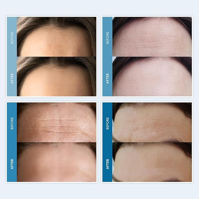 Dersie Silicone Forehead Wrinkle Patches (3 Count (Pack of 1))