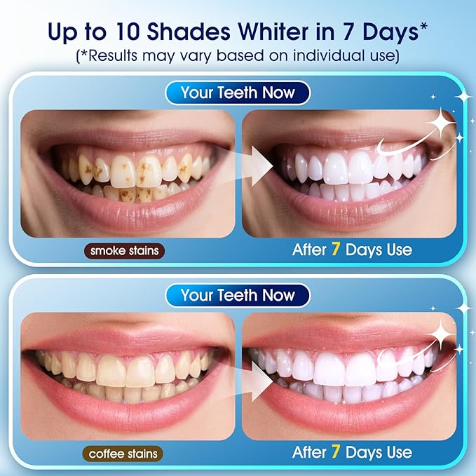 Teeth Whitening Kit – 3 Teeth Whitening Pens + 2 Desensitizing Pens – LED Light – 35% Carbamide Peroxide – Safe & Dentist-Recommended – Fast 7-Day Visible Whitening + Remineralizing Care（Yuzu Citrus）