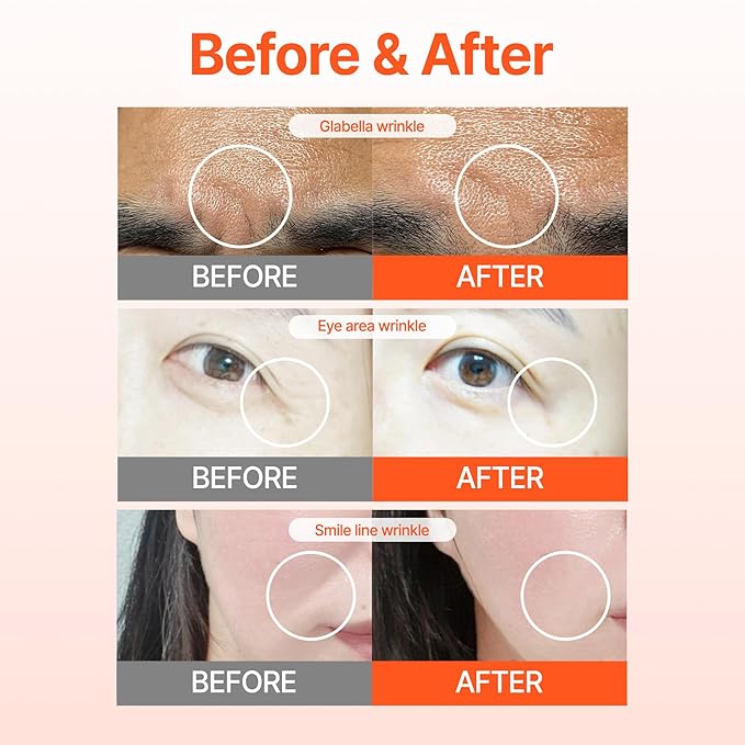 Wrinkle Patches ACROPASS RETI-RN Microcone, Deep Wrinkle, PDRN 10,000 ppm, Retinol 3,300 IU/g, Hyaluronic Acid, Anti-Aging (Slim Type, 6 Count)