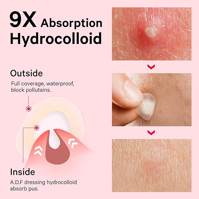 Sosky Pimple Patches for Face, FSA Eligible Invisible Hydrocolloid Acne Patches, Zit Sticker for Face and Skin, Pimple Sticker for Covering Zits, Blemishes with Salicylic Acid 57 Count