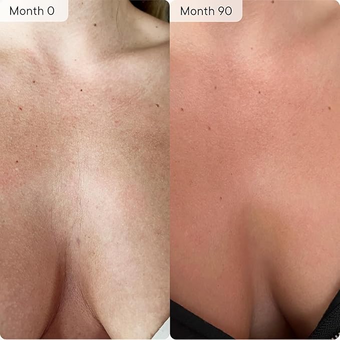 Qure Neck, Décolletage, Chest LED System, Red Light Therapy, 2 Wavelengths Red 633nm and Near-Infrared 830nm
