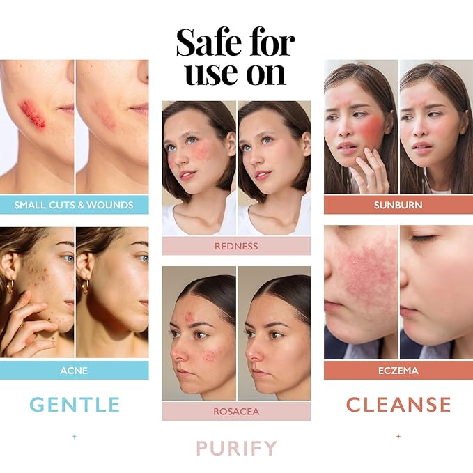 Hypochlorous Acid Spray for Face and Skin; Facial Cleanser | 2oz Face Mist Hypochlorous Acid Spray for Skin, Acne, Rash, Eczema, Wound | Antimicrobial Facial Cleanser Acne Sprays; Smart Skincare