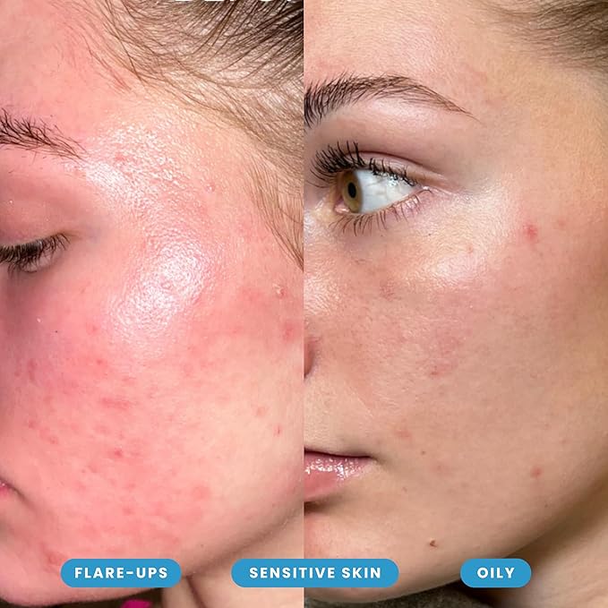 Hypochlorous Acid Spray – Dermatologist Tested HOCl Facial Cleanser for Sensitive, Acne-Prone & Irritated Skin – Soothes Redness, Eczema, Rashes & Itching – Skin Repair Spray, 6.8 oz - Honeydew Labs
