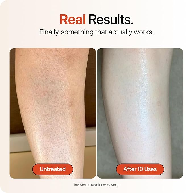 STRAWBERRY® Resurfacing Cream for Keratosis Pilaris - KP Bump Eraser Skin - Exfoliating Lotion with Glycolic, Lactic & Salicylic Acid - Remover for Rough & Bumpy Skin 8 oz (2 pack)
