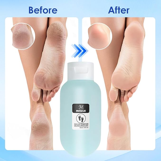 MOWLIE Professional Callus Remover for Feet – Extra Strength Foot Callus Remover Gel with 2 Glass Sandpaper Discs for Electric Foot Callus Remover,Foot Care kit - 50 ml/1.76 fl.oz