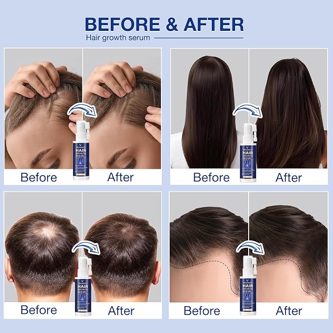 VENANOCI Hair Growth Oil Spray: Natural Hair Regrowth Serum with Rosemary, Biotin – Anti-Hair Loss Treatment for Thinning Hair – Promotes Thicker, Fuller Hair for Women & Men
