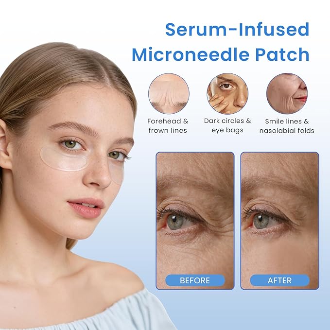 Micro-Dart Under Eye Patches for Puffiness, Dark Circles & Fine Lines | Hyaluronic Acid, Retinol, Collagen, Peptides, Vitamin C & Niacinamide | Korean-Inspired Eye Care (8 Pack)
