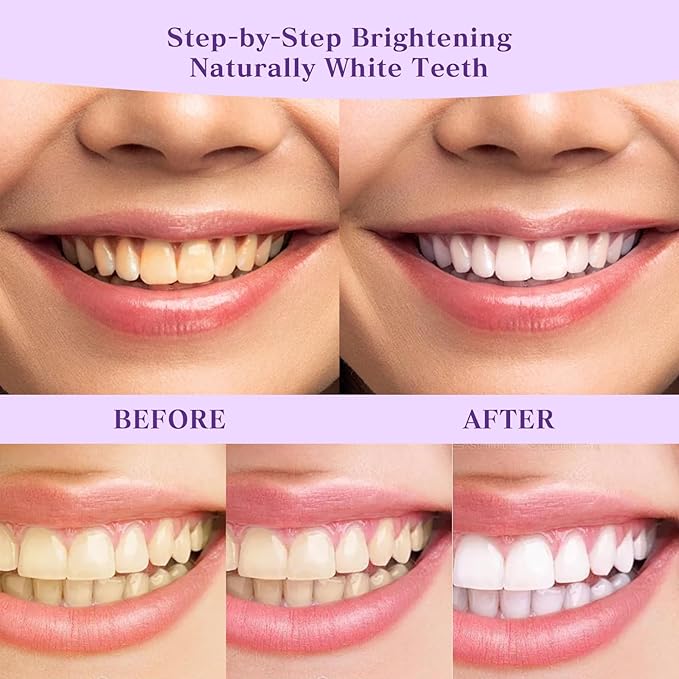 2 PCS Teeth Whitening Powder, R5X Advanced Purple Color Balance Toothpaste, Nano Hydroxyapatite Remineralizing (Enamel Repair) & Niacinamide Formula - Immediate Whitening Results, 2 * 50 Grams